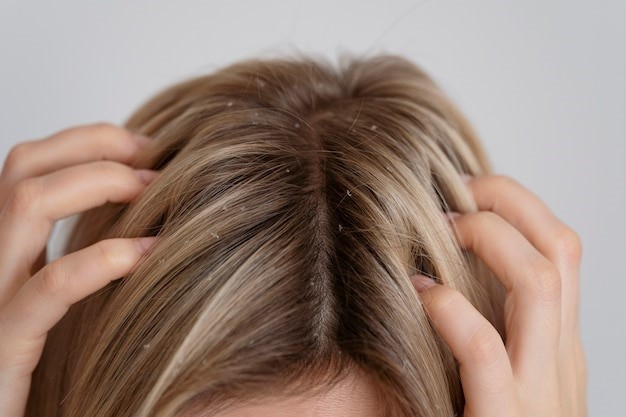 Pencegahan Infestasi Kutu Rambut 